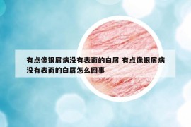 有点像银屑病没有表面的白屑 有点像银屑病没有表面的白屑怎么回事