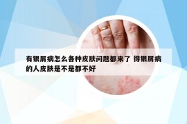 有银屑病怎么各种皮肤问题都来了 得银屑病的人皮肤是不是都不好