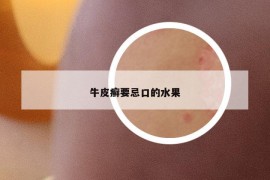 牛皮癣要忌口的水果