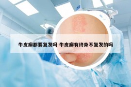 牛皮癣都要复发吗 牛皮癣有终身不复发的吗