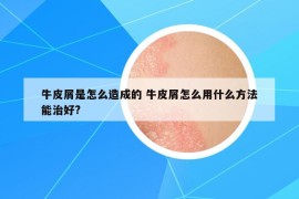 牛皮屑是怎么造成的 牛皮屑怎么用什么方法能治好?