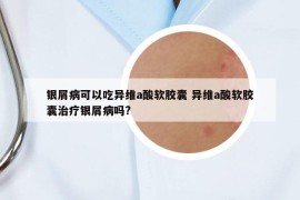 银屑病可以吃异维a酸软胶囊 异维a酸软胶囊治疗银屑病吗?