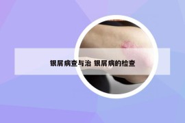 银屑病查与治 银屑病的检查