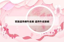 家族遗传病牛皮癣 遗传牛皮肤癣