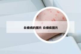 白癞病的图片 白癞疯图片