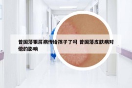曾国藩银屑病传给孩子了吗 曾国藩皮肤病对他的影响