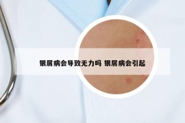 银屑病会导致无力吗 银屑病会引起