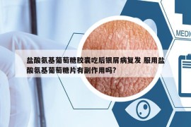 盐酸氨基葡萄糖胶囊吃后银屑病复发 服用盐酸氨基葡萄糖片有副作用吗?