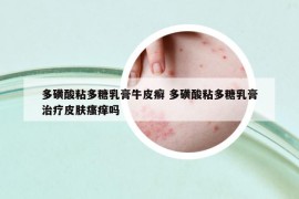多磺酸粘多糖乳膏牛皮癣 多磺酸粘多糖乳膏治疗皮肤瘙痒吗