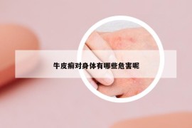 牛皮癣对身体有哪些危害呢