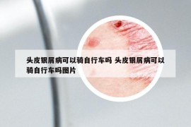 头皮银屑病可以骑自行车吗 头皮银屑病可以骑自行车吗图片