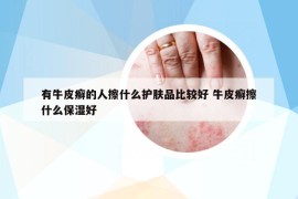 有牛皮癣的人擦什么护肤品比较好 牛皮癣擦什么保湿好