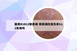 服用B1B12银屑病 银屑病吃维生素b12有用吗