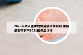 2023年纳入医保的银屑病生物制剂 银屑病生物制剂2021医保后价格