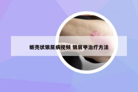 蛎壳状银屑病视频 银屑甲治疗方法