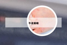 牛皮癣晴