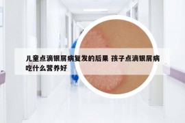 儿童点滴银屑病复发的后果 孩子点滴银屑病吃什么营养好