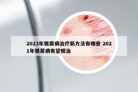 2023年银屑病治疗新方法有哪些 2021年银屑病有望根治