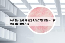 牛皮怎么治疗 牛皮怎么治疗?告诉你一个简单显效的治疗方法