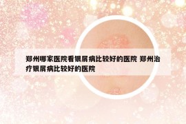 郑州哪家医院看银屑病比较好的医院 郑州治疗银屑病比较好的医院