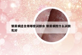 银屑病适合用哪些润肤水 银屑病擦什么润肤乳好