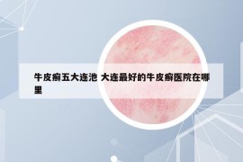 牛皮癣五大连池 大连最好的牛皮癣医院在哪里