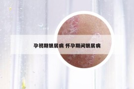孕初期银屑病 怀孕期间银屑病