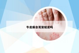 牛皮癣会耳背蜕皮吗