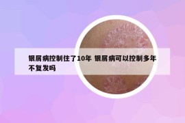 银屑病控制住了10年 银屑病可以控制多年不复发吗