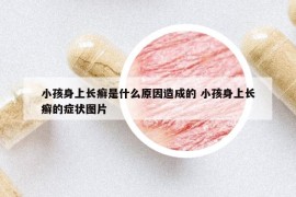 小孩身上长癣是什么原因造成的 小孩身上长癣的症状图片