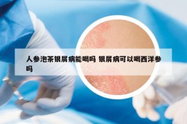 人参泡茶银屑病能喝吗 银屑病可以喝西洋参吗