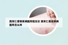西安仁爱银屑病医院程主任 西安仁爱皮肤病医院怎么样