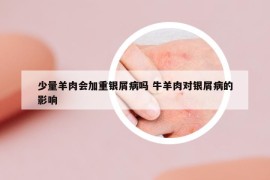 少量羊肉会加重银屑病吗 牛羊肉对银屑病的影响