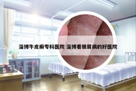 淄博牛皮癣专科医院 淄博看银屑病的好医院