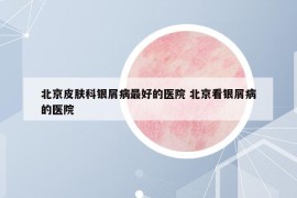 北京皮肤科银屑病最好的医院 北京看银屑病的医院