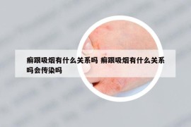 癣跟吸烟有什么关系吗 癣跟吸烟有什么关系吗会传染吗