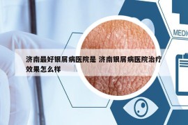 济南最好银屑病医院是 济南银屑病医院治疗效果怎么样