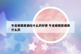 牛皮癣银屑病吃什么药好使 牛皮癣银屑病用什么药
