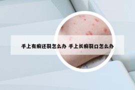 手上有癣还裂怎么办 手上长癣裂口怎么办