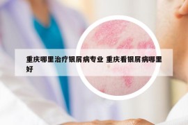 重庆哪里治疗银屑病专业 重庆看银屑病哪里好
