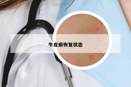 牛皮癣恢复状态