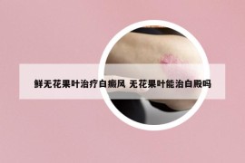 鲜无花果叶治疗白癜风 无花果叶能治白殿吗