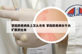 掌跖脓疱病身上怎么也有 掌跖脓疱病会不会扩散到全身