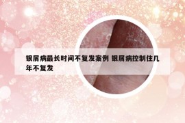 银屑病最长时间不复发案例 银屑病控制住几年不复发