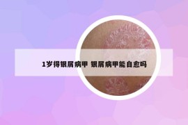 1岁得银屑病甲 银屑病甲能自愈吗