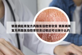 银屑病能用复方丙酸氯倍他索软膏 银屑病用复方丙酸氯倍他索软膏过敏还可以抹什么药