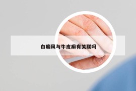 白癜风与牛皮癣有关联吗