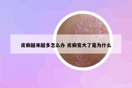 皮癣越来越多怎么办 皮癣变大了是为什么