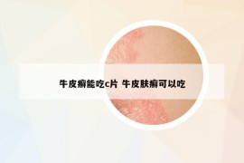 牛皮癣能吃c片 牛皮肤癣可以吃