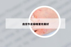 南京牛皮癣哪里效果好